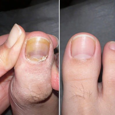 EPIDEX Fungal Nail Renewal Patches (3 Months)