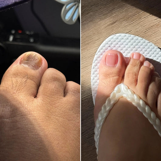 EPIDEX Fungal Nail Renewal Patches (1 Months)